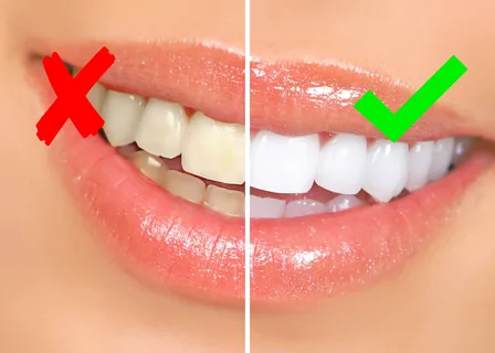 Teeth Whitening Cleveland